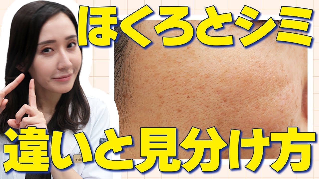 しみ ほくろ 違い