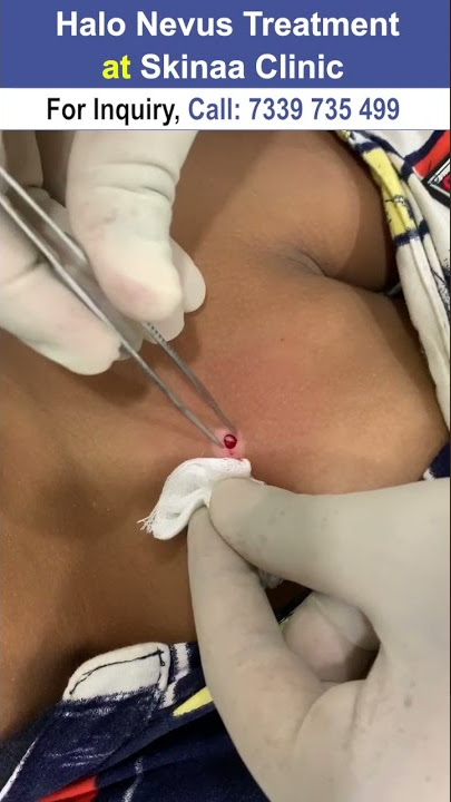 Halo Nevus at skinaa clinic #halo #halonevus #skinaaclinic #skinaa_clinic