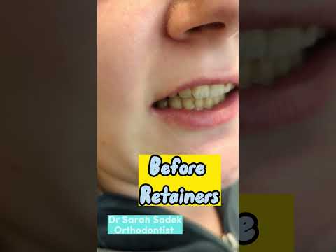 Retainers After Braces