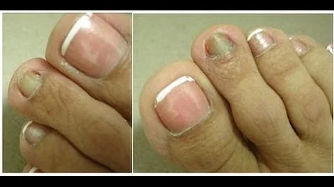 O que fazer para clarear as unhas escuras?