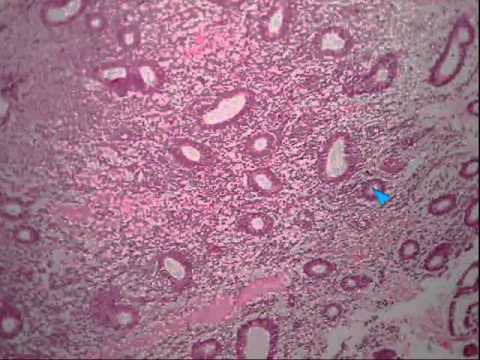 What is the treatment for disordered proliferative endometrium?