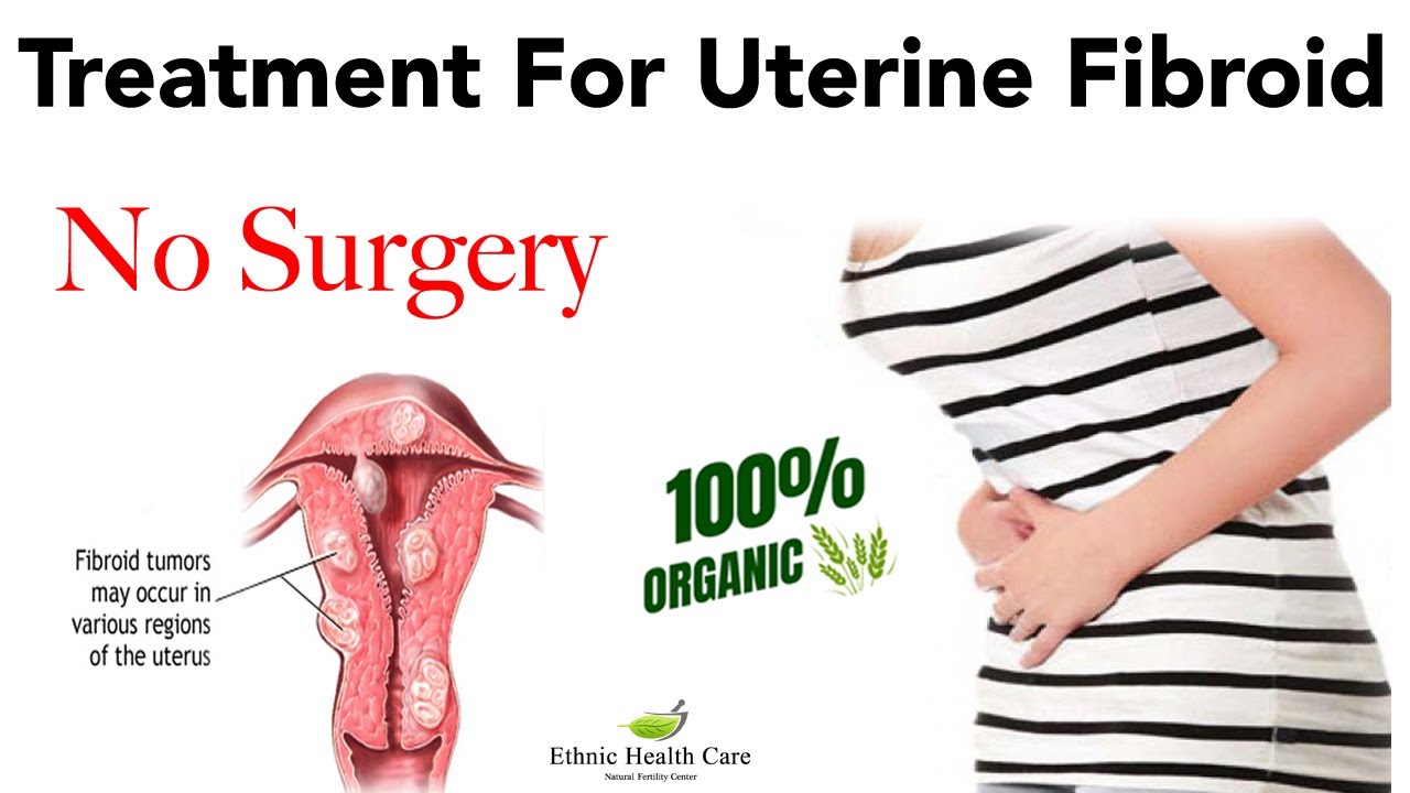 ಗರ್ಭಾಶಯದ ಫೈಬ್ರಾಯ್ಡ್ ಉತ್ತಮ ಚಿಕಿತ್ಸೆ Best Treatment For Uterine Fibroid
