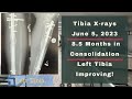 Height Journey - Tibia X-rays 8.5 Months In Consolidation - June 5, 2023