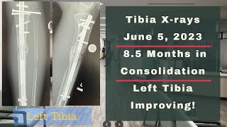 Height Journey - Tibia X-rays 8.5 Months In Consolidation - June 5, 2023