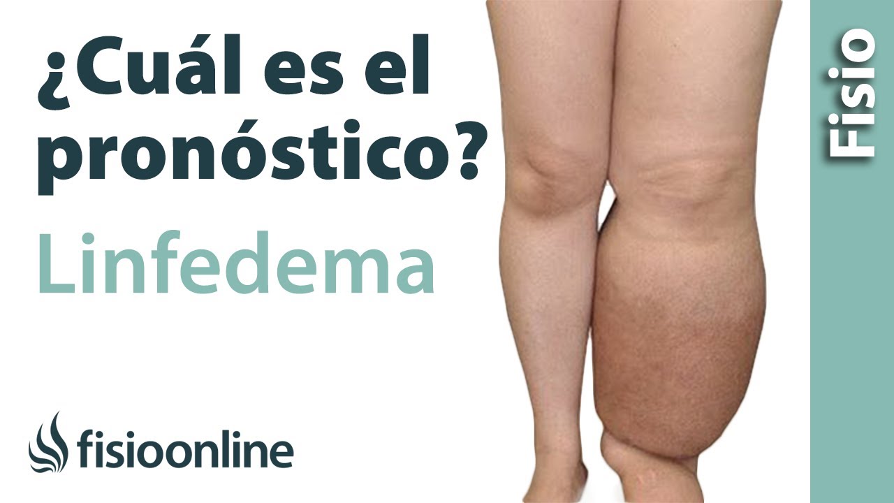 🦵🏻¿Cuál es el PRONÓSTICO del LINFEDEMA?🤔