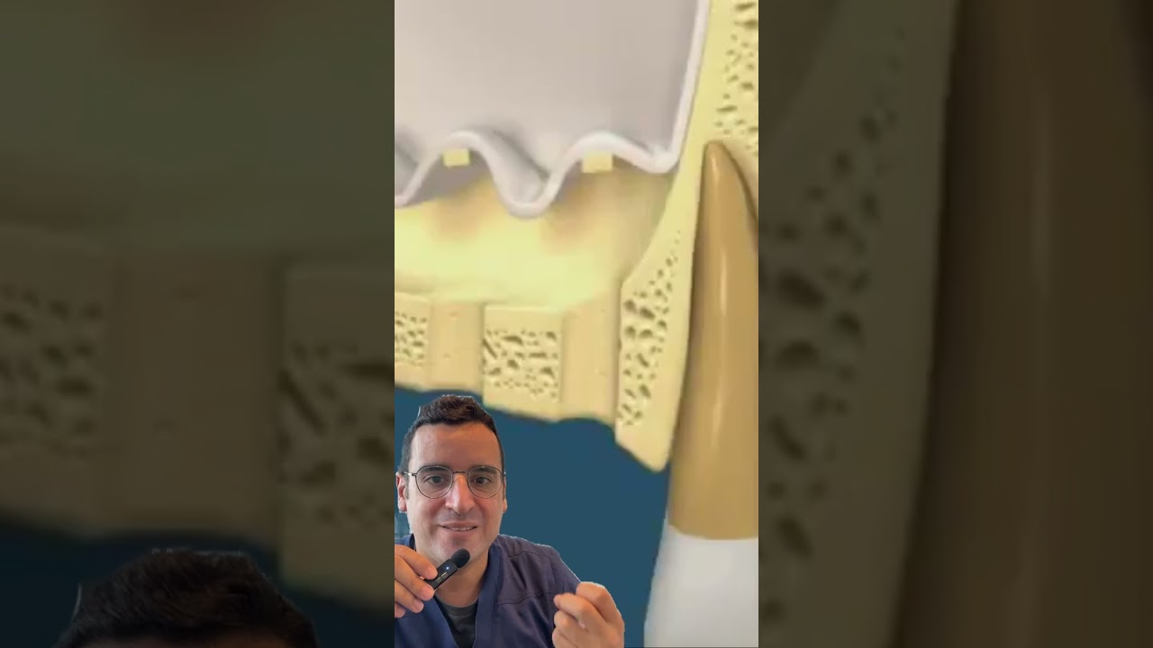 IMPLANT dentaire et GREFFE osseuse au SINUS👇🏻