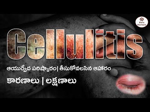 Cellulitis | Ayurvedic Medicines For Cellulitis | Food Diet #baluherbals #celulitis #medicine - video from Balu Herbals