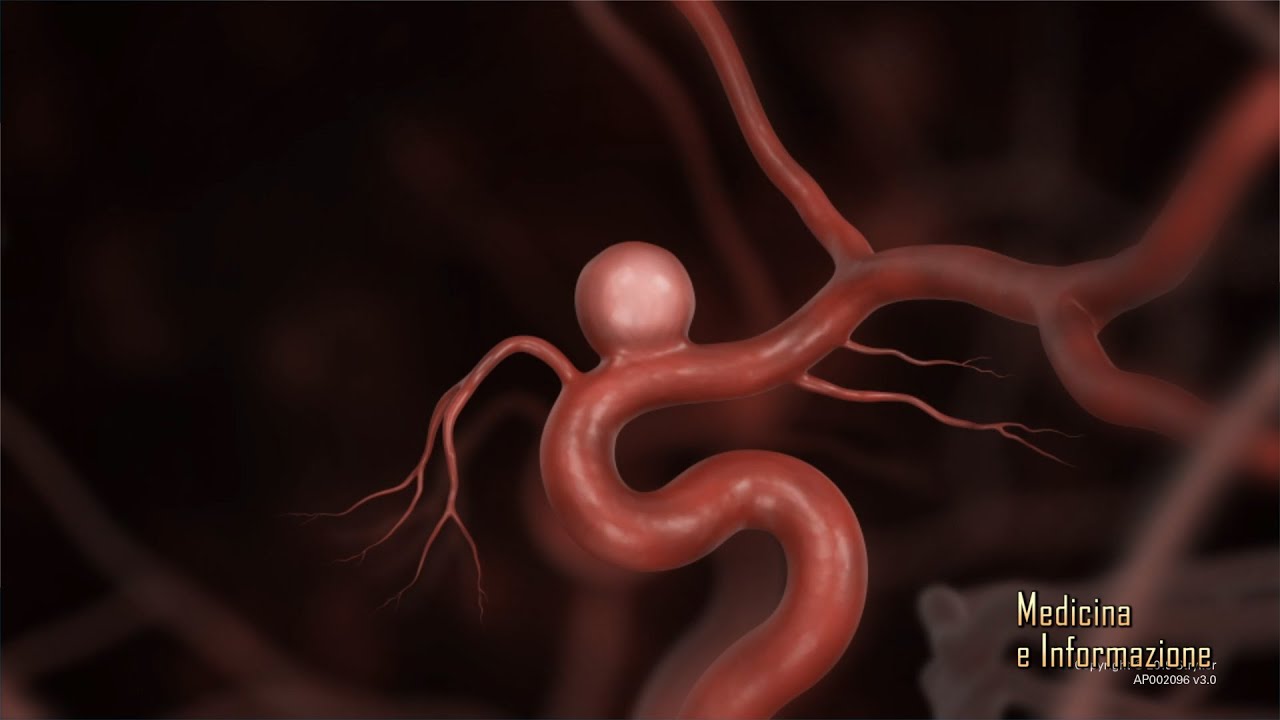 Aneurismi Cerebrali: le nuove tecniche non invasive per la riparazione con stent e spirali
