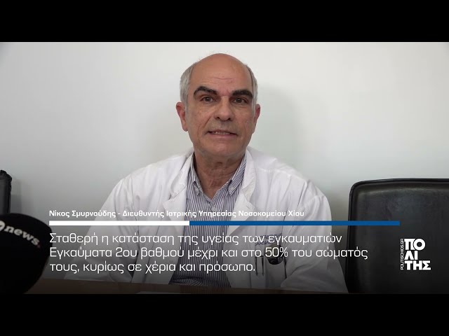 Νίκος Σμυρνιούδης - Ελεγχόμενη η κατάσταση των εγκαυματιών