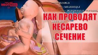 Кесарево сечение как проводят ?