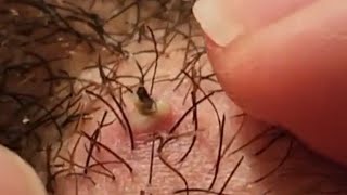 Reddit's Worst Ingrown Hair of 2023