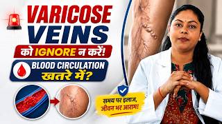 पैरों की उभरी नसें सिर्फ Beauty Issue नहीं! Varicose Veins की सच्चाई | Blood Circulation Warning