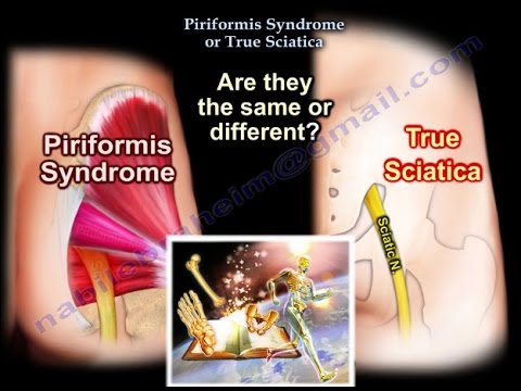 PIRIFORMIS SYNDROME EVERYTHING YOU NEED TO KNOW