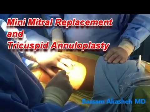 Minimally invasive mitral replacement and tricuspid annuloplasty - YouTube bassamakasheh