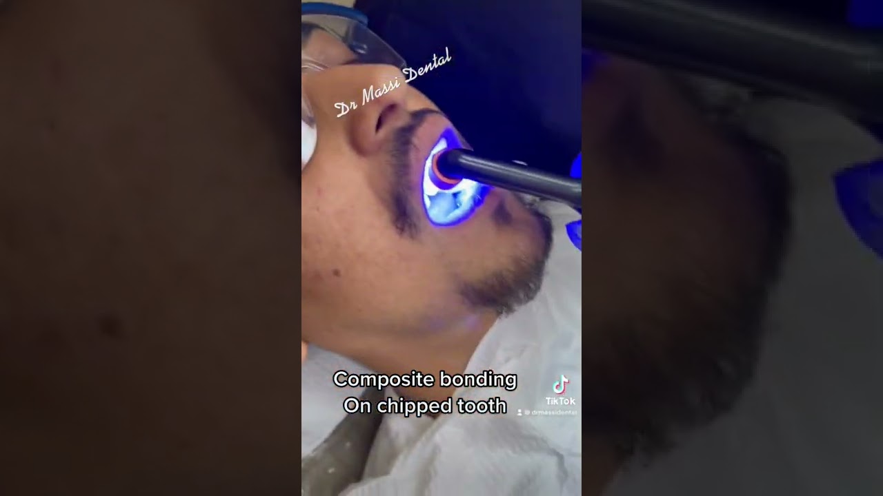 Composite bonding, chipped tooth
