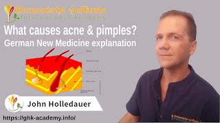 What causes acne & pimples? – German New Medicine explanation