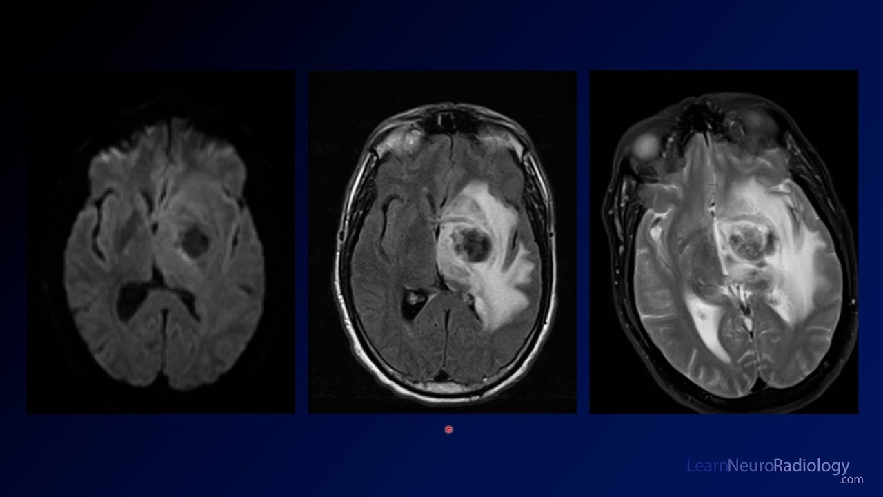 Process Tubaris Torus Tubarius Mri
