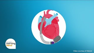 Full Managing Heart Failure with Abbott News