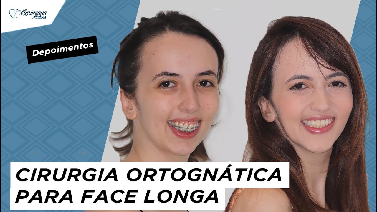 DEPOIMENTO CIRURGIA ORTOGNÁTICA | Face longa e Classe II - YouTube