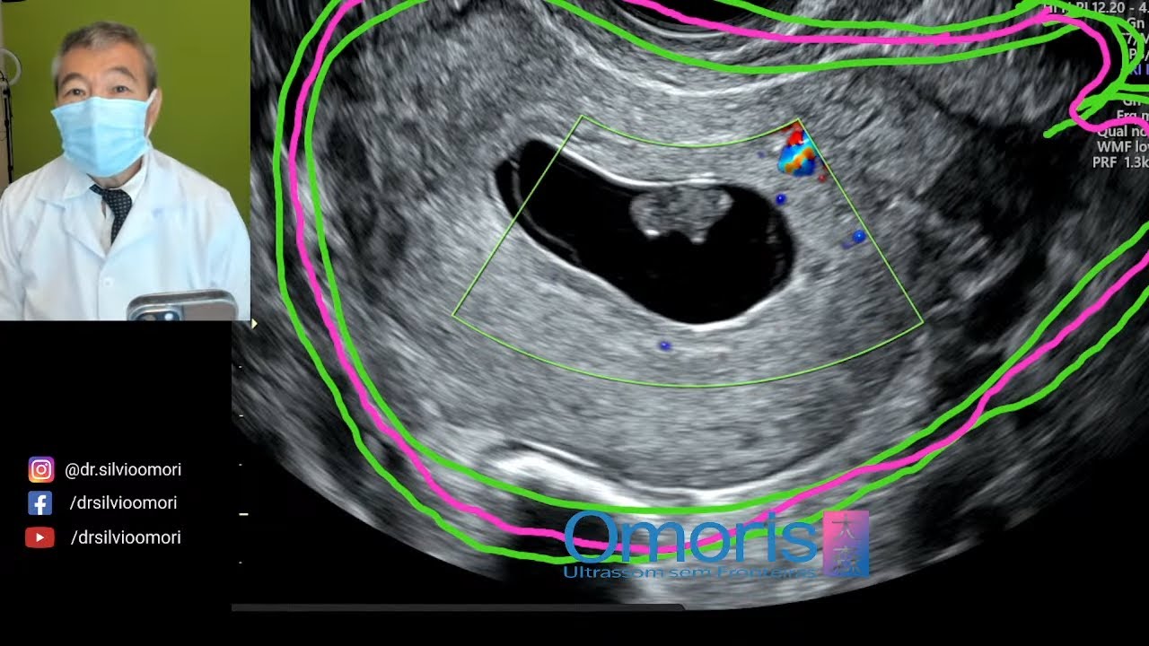 Пропущенный аборт - 9 недель