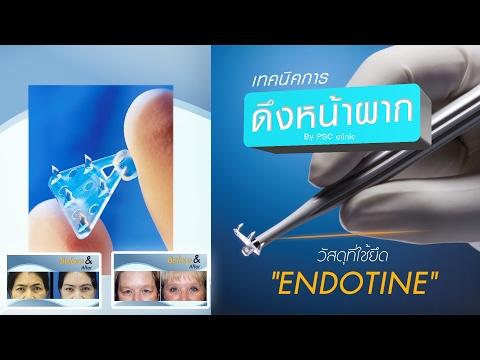 เทคโนโลยีการผ่าตัดดึงหน้าผากด้วยวัสดุ ENDOTINE By PSC Clinic