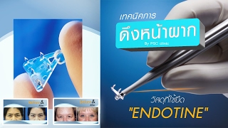 เทคโนโลยีการผ่าตัดดึงหน้าผากด้วยวัสดุ ENDOTINE By PSC Clinic