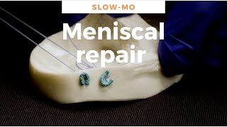 Meniscus repair using FiberStitch all inside suture repair - 1/5th speed