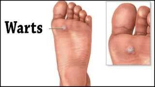 Foot Wart (Plantar Wart) - Podiatrist, Dr. Ken Lefkowitz Talks About Warts