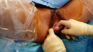 Vaginal Cyst Resection