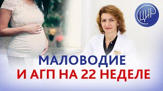 Маловодие, диффузное утолщение плаценты и антенатальная гибель плода на 22 неделе беременности.