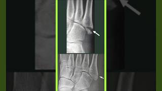 Avulsion fracture of the 5th metatarsal base 5th Metatarsal Base Avulsion Fracture
