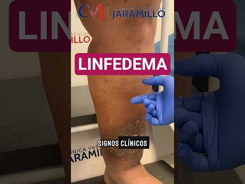 Linfedema en el pie por obesidad: por qué puede ocurrir