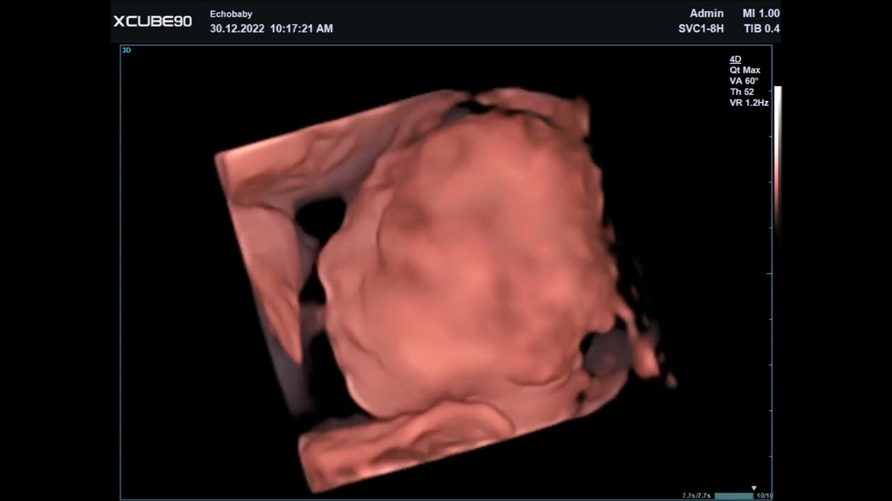 2D en 3D Baby Echo Tweeling 23 Weken Zwanger