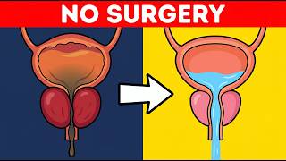 how to reduce prostate size without surgery (permanently)