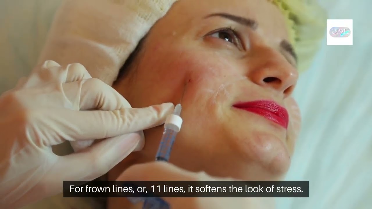 Why Everyone’s Choosing Botox for Wrinkles & Fine Lines in Dripping Springs