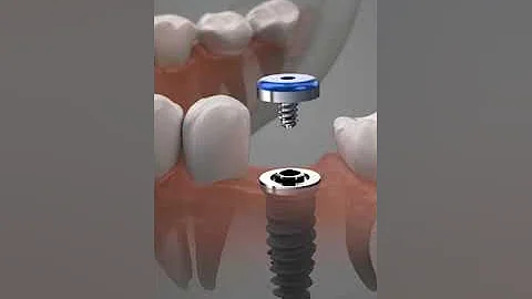 Dental Implants Procedure #animation #surgery #dentist #implant #teeth