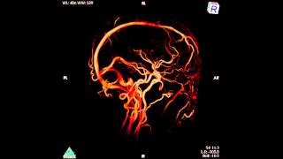 Non contrast enhanced brain MRA at 3.0 Tesla