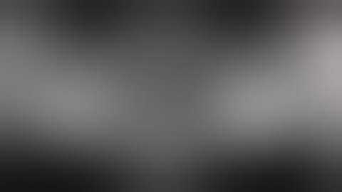 Bilateral 3 D Ridge Augmentation using Stick Bone