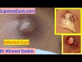 Infected Cyst. Dr Khaled Sadek. LipomaCyst.com