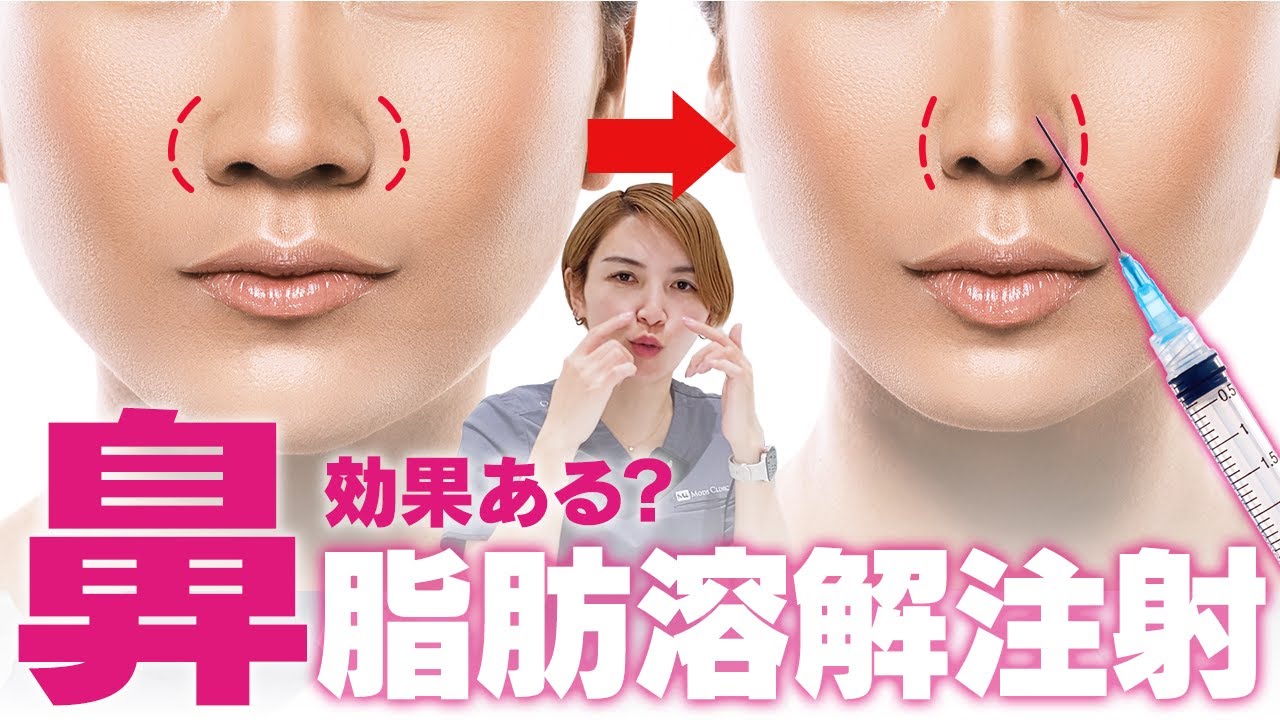 話題の『鼻の脂肪溶解注射』効果あるのか論争に終止符を！現役美容外科女医が結論出します！｜脂肪吸引の母#223