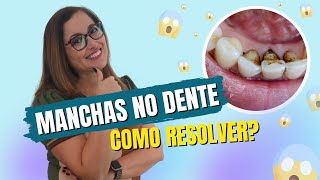 How to get rid of stains on teeth? Adornare Aesthetic Dentistry in Santos How to get rid of stains on teeth? Adornare Aesthetic Dentistry in Santos