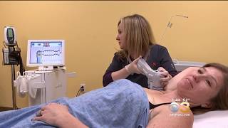 miraDry- A Solution For Underarm Sweat, Philadelphia- Dr. Ringpfeil CBS3 News