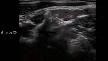 Cervical Plexus Block - Nerve Localization, Examination C7 to C3