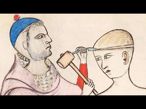 Трепанация черепа