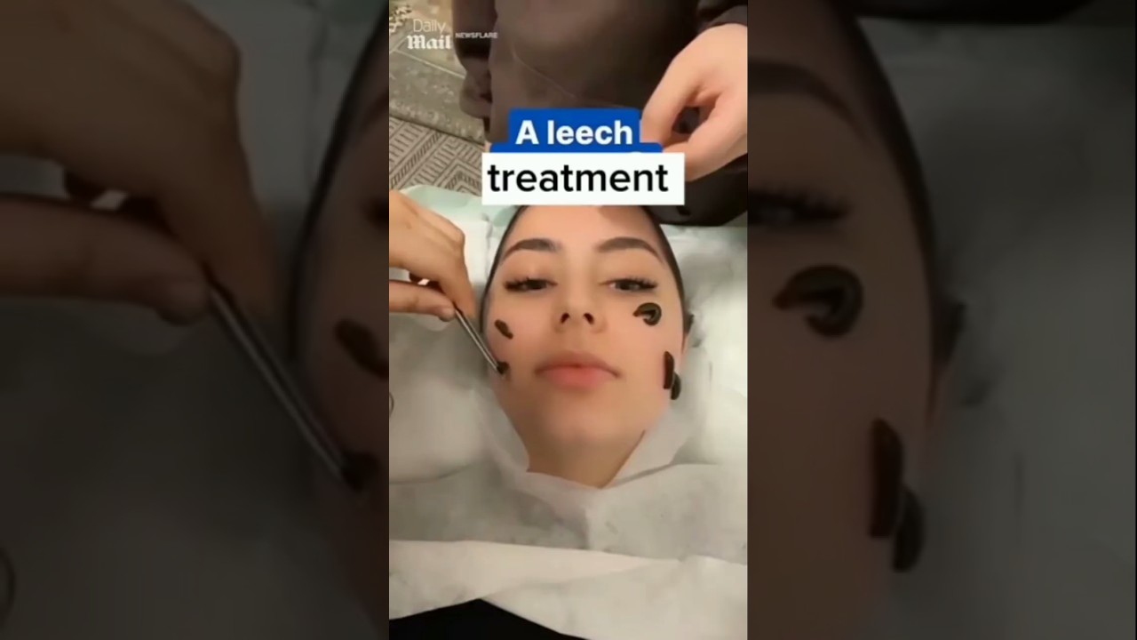 leech treatment unicure ayurvedic panchakarma