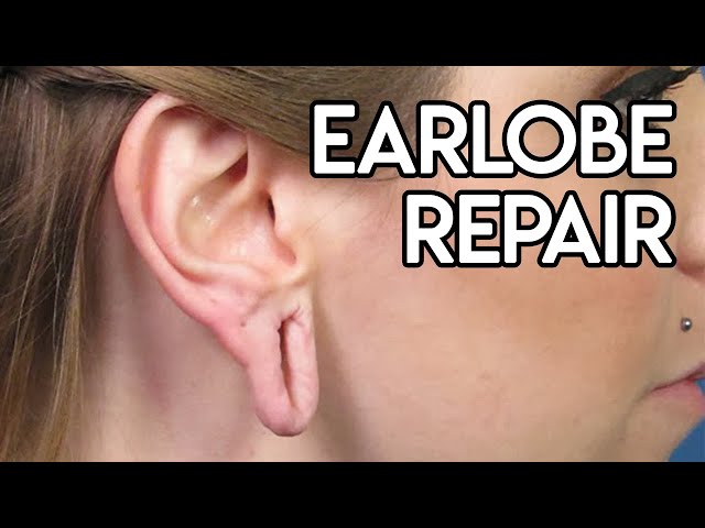 Earlobe Repair