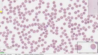 Hematopathology case 2 - Give your diagnosis