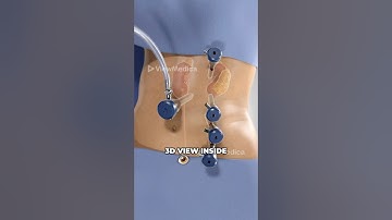 Robotondersteunde nierverwijdering bij mensen (3D-animatie)