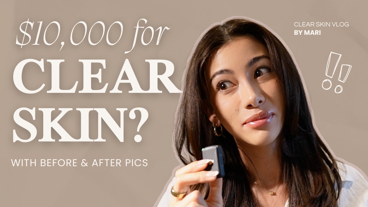 $10,000 Laser to Permanently Cure Acne- I tried it. (ACCURE)