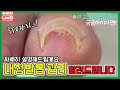 내성발톱 3TO관리방법 ingrowing nail(3TO is similar to the principle of orthodontics) - 레푸스 남양주호평점 Refuss